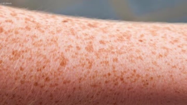 DAS hast du &uuml;ber Sommersprossen garantiert noch nicht gewusst!