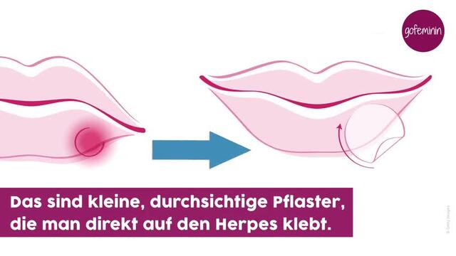 Herpes was tun